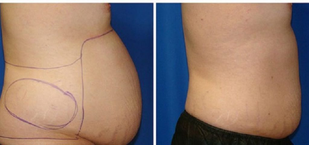 عمل لیپوپلاستی