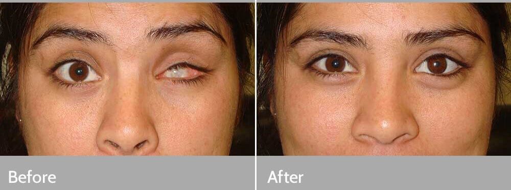 پروتز چشم یا چشم مصنوعی چیست-وبسایت دکتر شهرام مفاضی